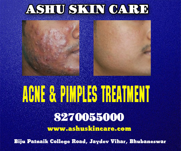 best acne and pimples treatment clinic in bhubaneswar near ayush hospital